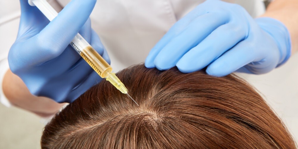 what-is-prp-treatment-for-hair