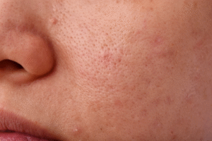 Close-up of facial skin with visible large pores and mild blemishes, illustrating the need for Pore Reduction Treatment in Himayatnagar