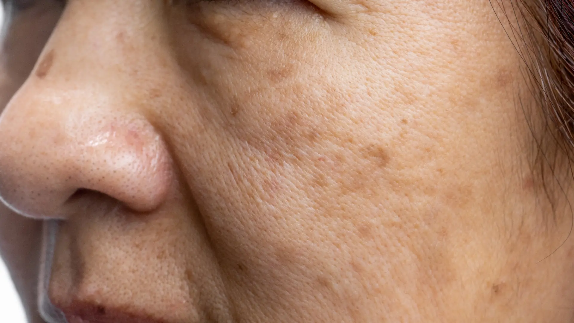 Facial skin pigmentation and tan issues on cheek area, showing uneven skin tone treated by skin specialists in Himayatnagar.