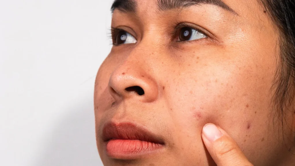 Pigmentation & Tan Issues in Himayatnagar: Expert Tips From Skin Specialists